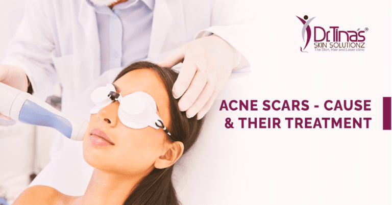 Acne Scars Causes And Their Treatment Skin Solutionz