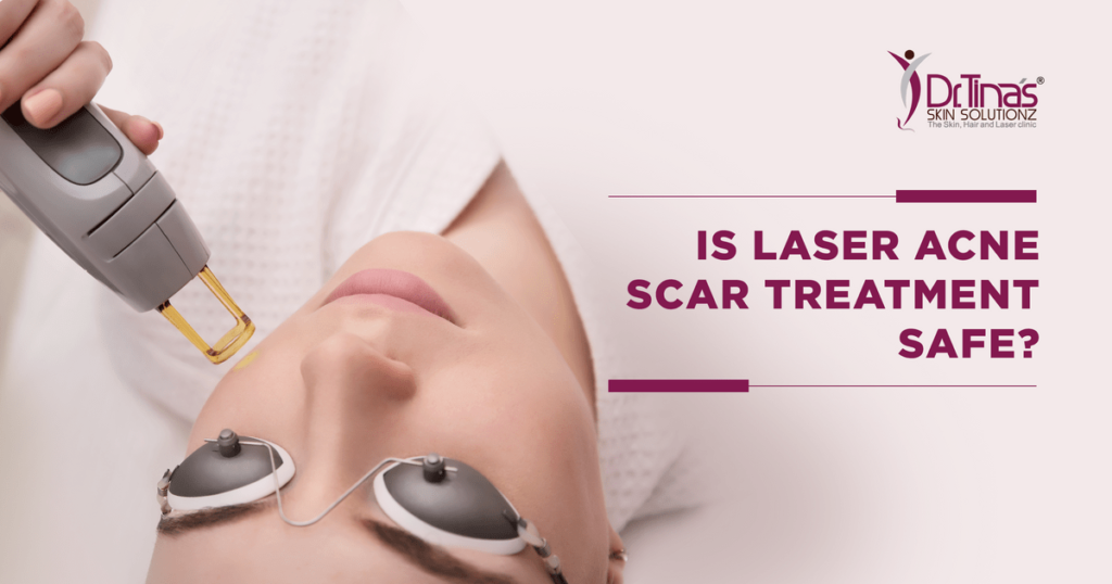 Is Laser Treatment For Acne Scars Safe Skin Solutionz
