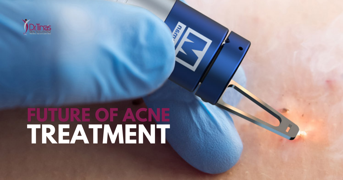 The Future of Acne Treatment: Exploring Blue Laser Technology