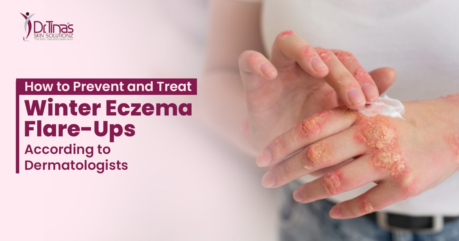 How to Prevent and Treat Winter Eczema Flare-Ups According to Dermatologists